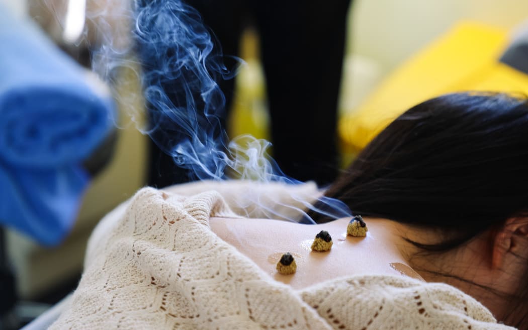 Chinese medicine, moxibustion