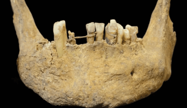 500 Year Old Gold Dental Implant Unearthed In Scotland Reveals Surprisingly Advanced Medieval Dentistry
