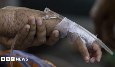 A child's arm covered in blisters, with tape around its hand and a cannula, held up by an adult's hand