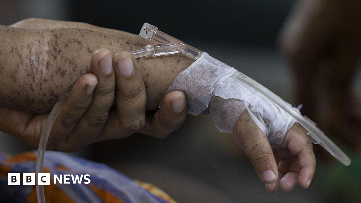 A child's arm covered in blisters, with tape around its hand and a cannula, held up by an adult's hand