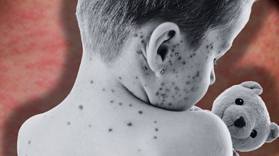 The number of US children catching measles is rising.