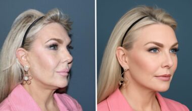 AI Images Are Distorting Plastic Surgery Expectations