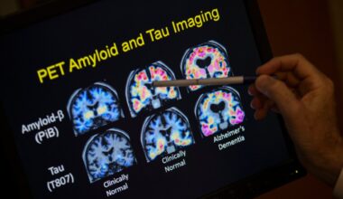 Alzheimer’s deaths increase as population ages, lifespans increase – The Mercury News