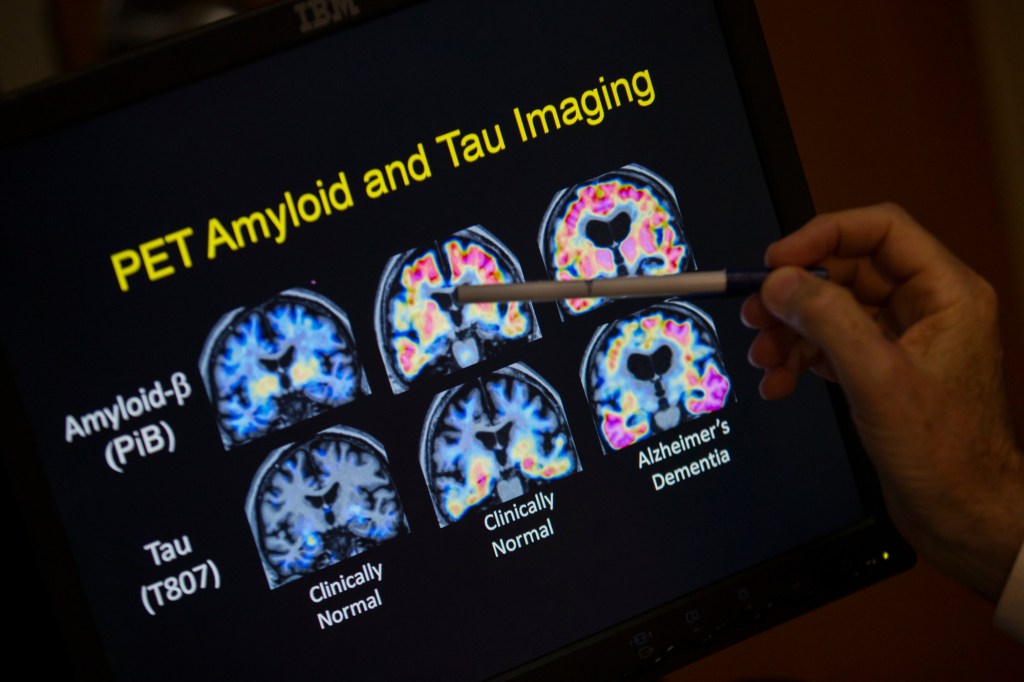 Alzheimer’s deaths increase as population ages, lifespans increase – The Mercury News
