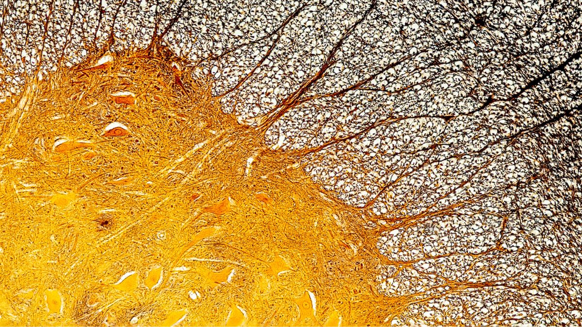 World MS Day: Immune Cell Discovery Might Explain Multiple Sclerosis at Its Worst : ScienceAlert