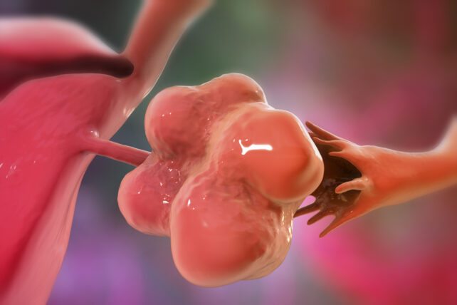 PMOS Ovary