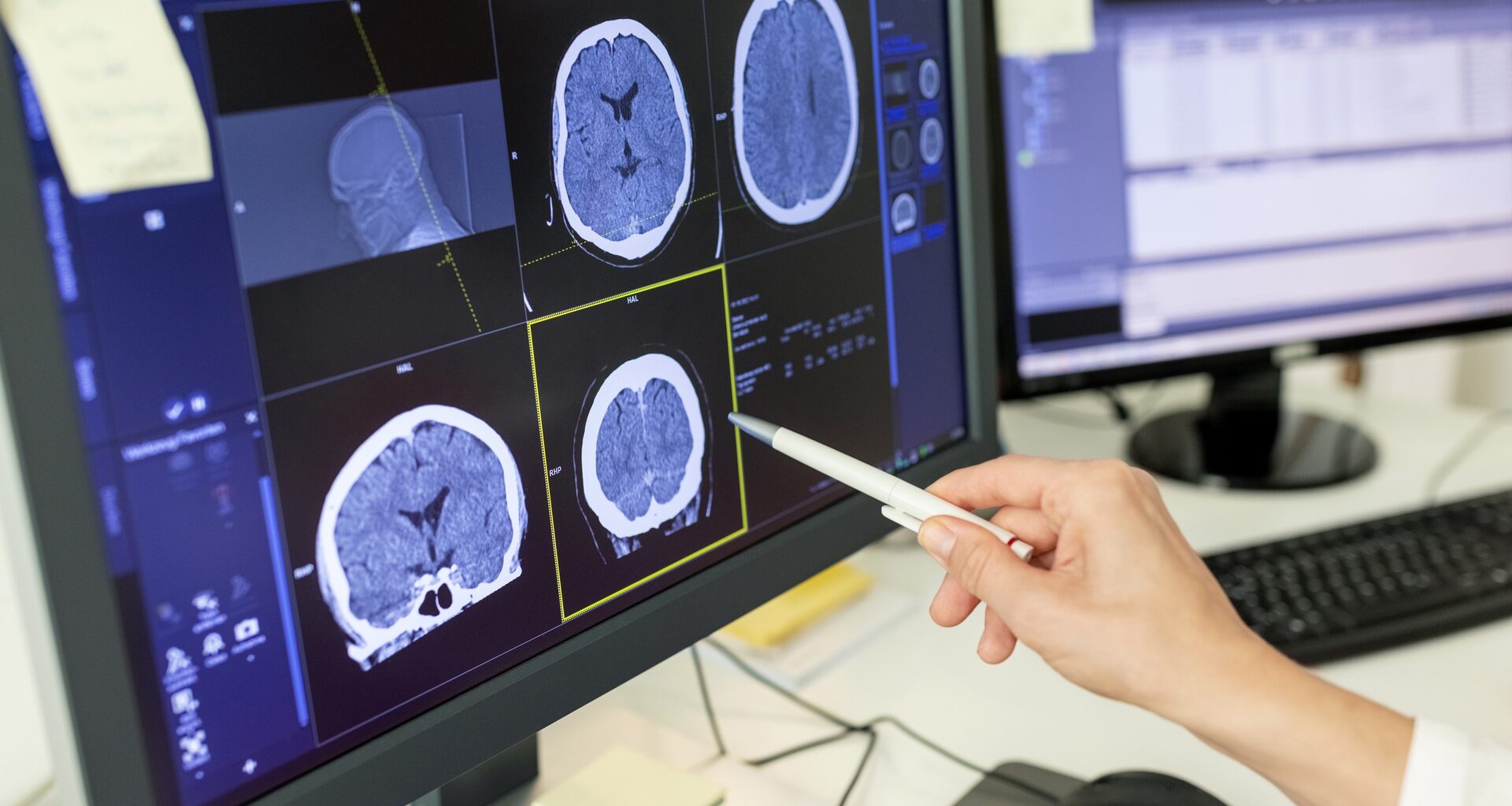 How smart choices and quicker response can outsmart stroke