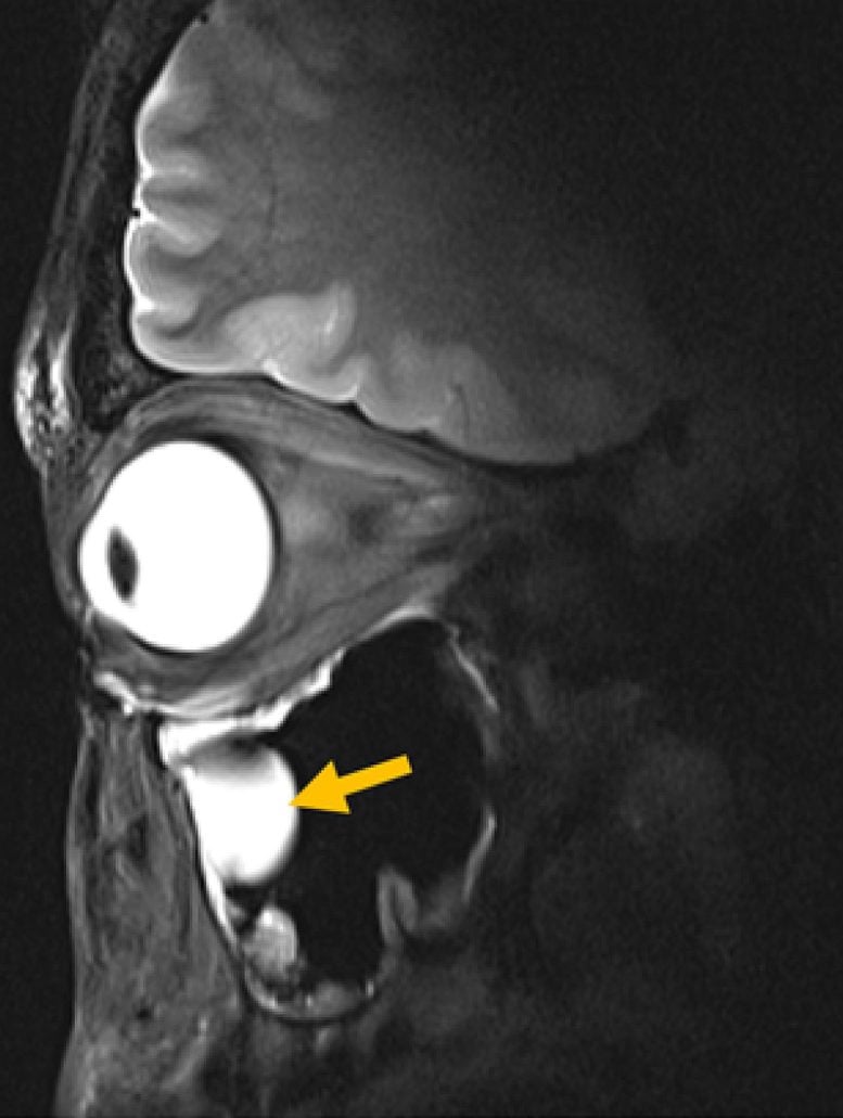 High Resolution 7.0 T MRI of the Eye and Orbit