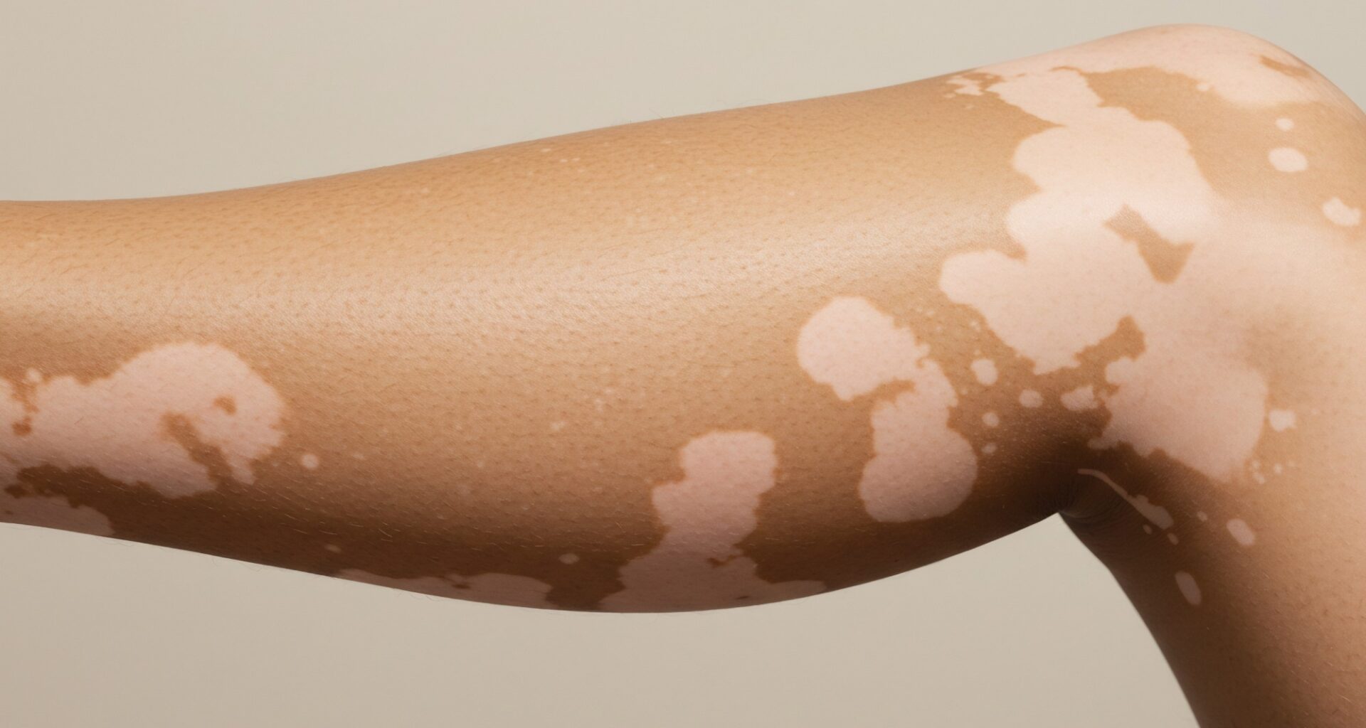 Diet and inflammation may play a role in progressive vitiligo