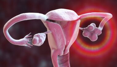 PCOS Is Officially Renamed, After Decades of Misinformation : ScienceAlert