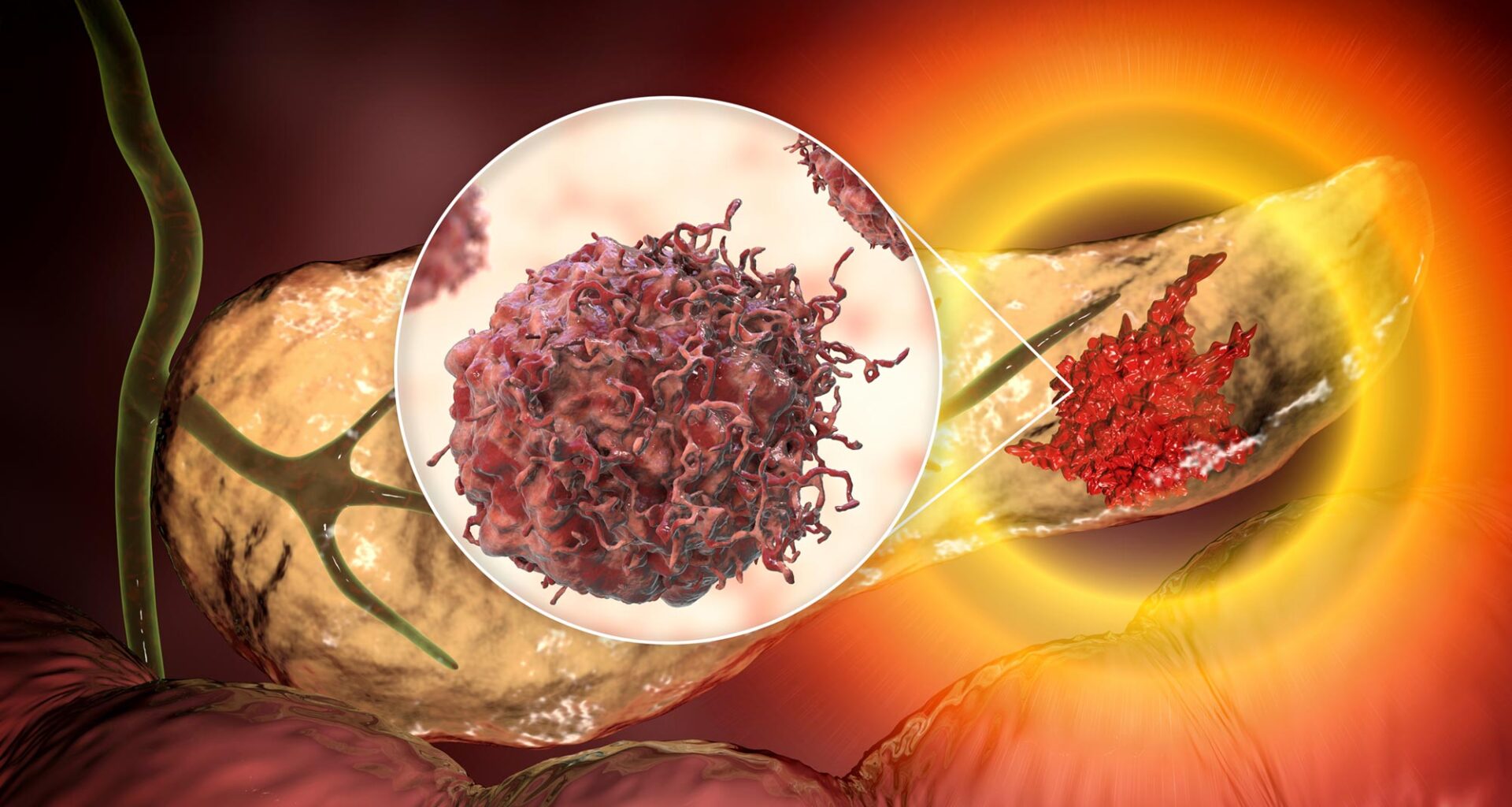 Pancreatic Cancer Malignant Tumor Cell Inset