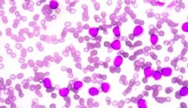 Common anemia drugs may help slow cancer growth and progression