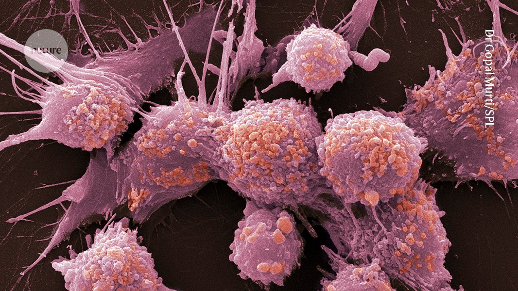 Does the PSA test for prostate cancer save lives? New data reverse gold-standard findings