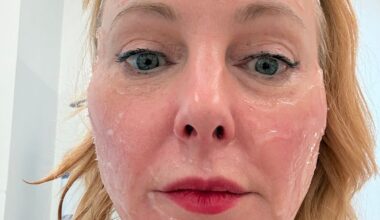 XERF Latest Skin Tightening From Korea: Review and Tested