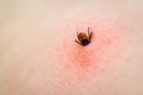 Close-up of a tick burrowing into a person's skin; the area immediately around it is inflamed.