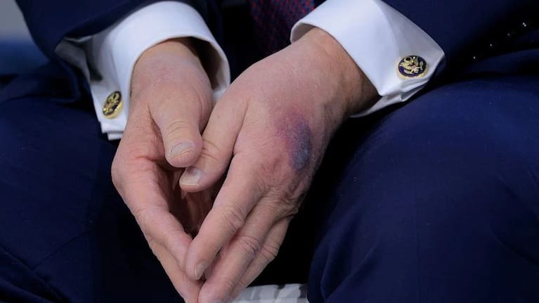 Bruising that has been seen numerous times on Trump's hand is said to be from hand shaking.
