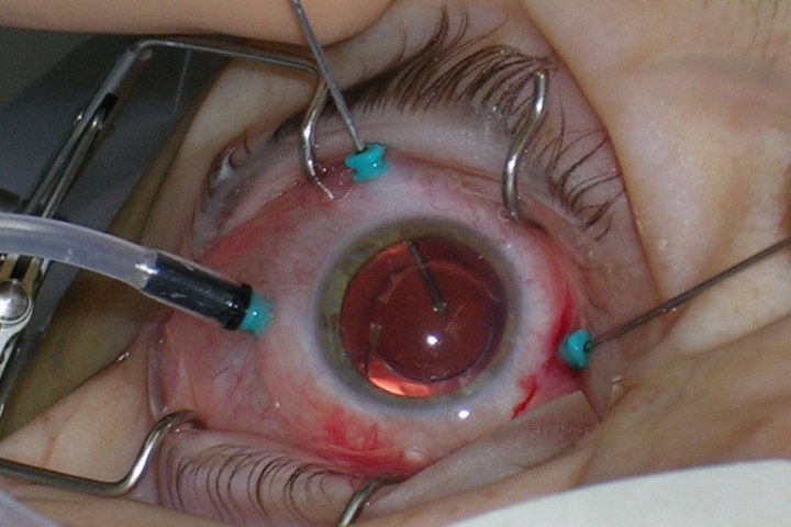 Eye to Eye: quizzing Drs Peter Hadden and Sophie Hill
