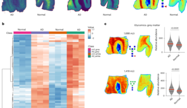 Hyperglycosylation is a metabolic driver of Alzheimer’s disease