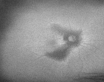 Black and white image of a retina with a large, dark, irregular-shaped haemorrhage and radiating blood vessels.