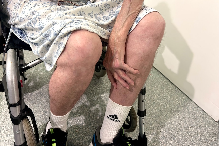 elderly person's legs in a wheel chair that are very thin