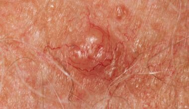 It's Not Just Your Moles: The Skin Changes That Could Flag Cancer