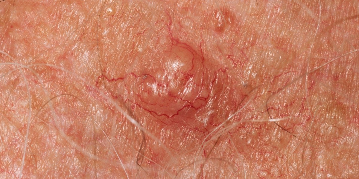 It's Not Just Your Moles: The Skin Changes That Could Flag Cancer
