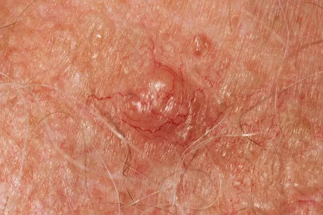 Skin cancer, close-up.
