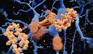 Women with Parkinson’s Have More Amyloid Plaques than Men