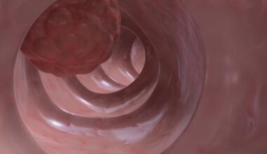 Gene deletion exposes hidden colon cancer cells to immunotherapy attack