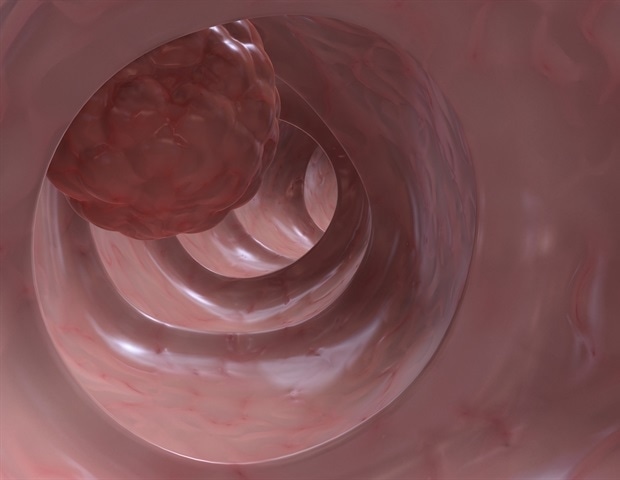 Gene deletion exposes hidden colon cancer cells to immunotherapy attack