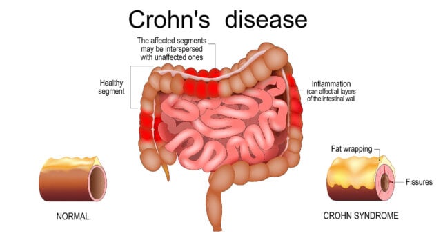 Crohn disease. Human large and small intestine with healthy segments and inflammation that affect layers of the intestinal wall. The affected segments interspersed with unaffected ones. Close-up of a cross section of a intestinal wall with fat wrapping and fissures