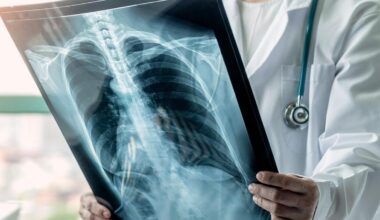 Can lung cancer be prevented using a drug?