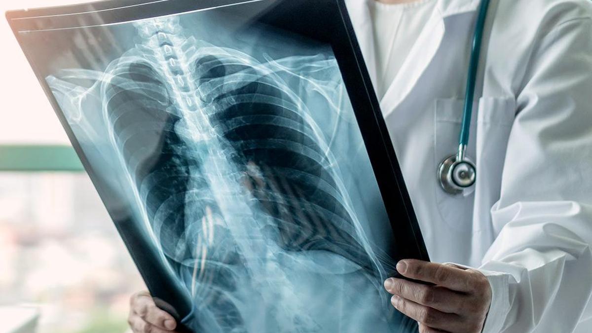 Can lung cancer be prevented using a drug?