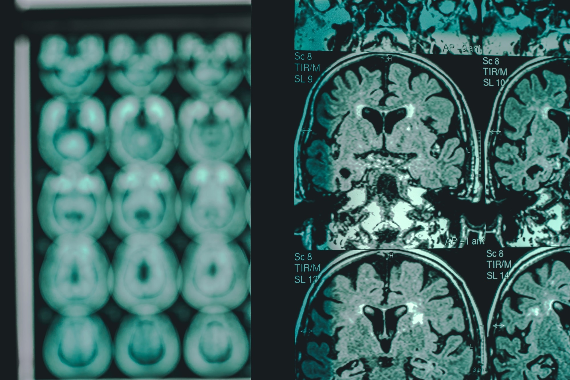 Study: Hyperglycosylation is a metabolic driver of Alzheimer’s disease. Image Credit: Atthapon Raksthaput / Shutterstock