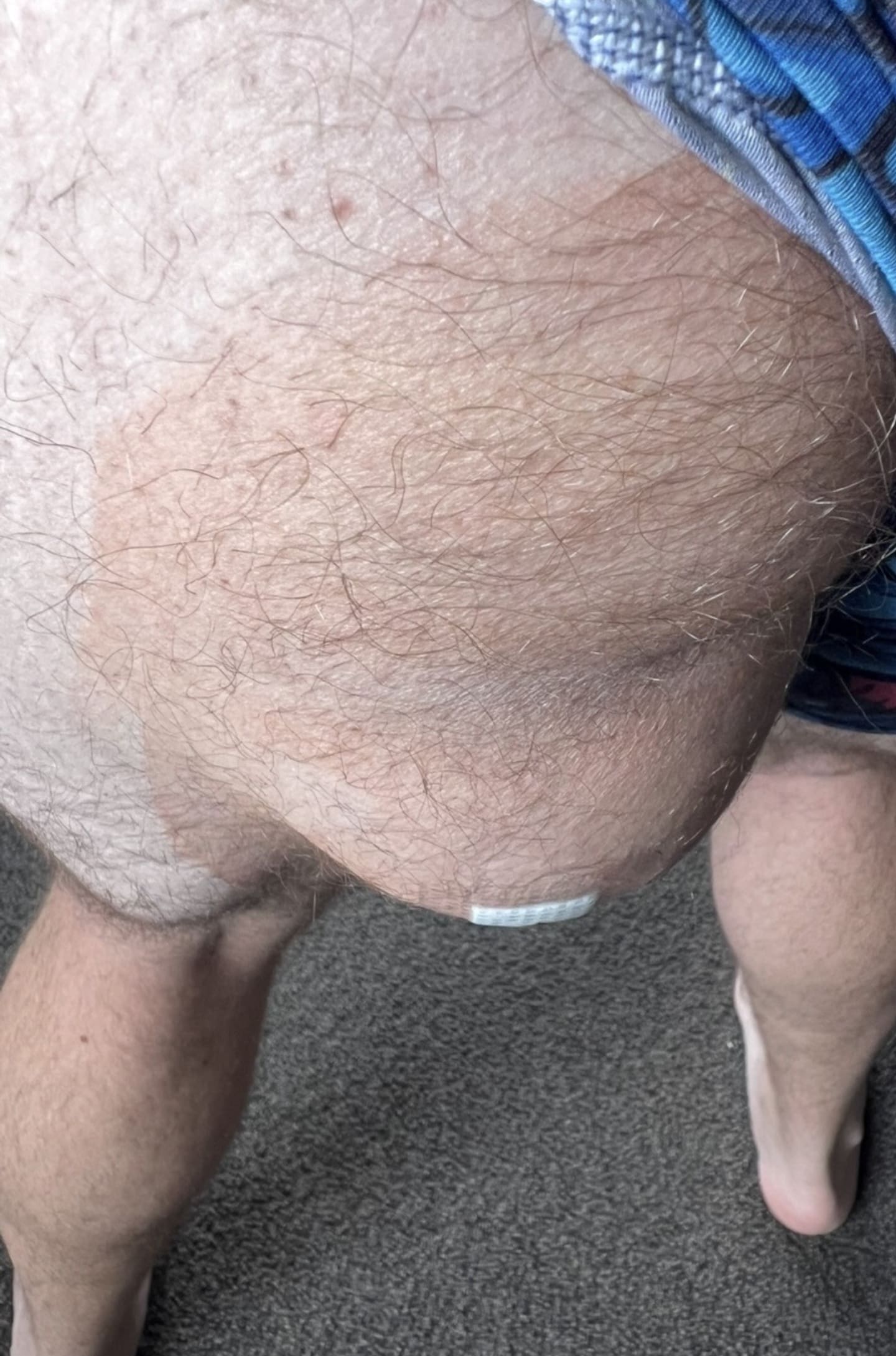 At first, he thought the lump was just muscle gain, but it grew rapidly, doubling in size until it was 20cm wide.