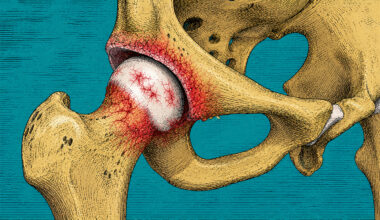 Osteoarthritis may be one disease after all, Oxford study finds