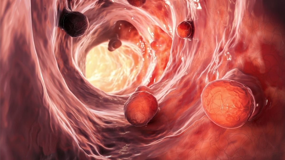 Gut Microbiome Could Remain Disrupted For Over a Decade After Polyp Removal : ScienceAlert