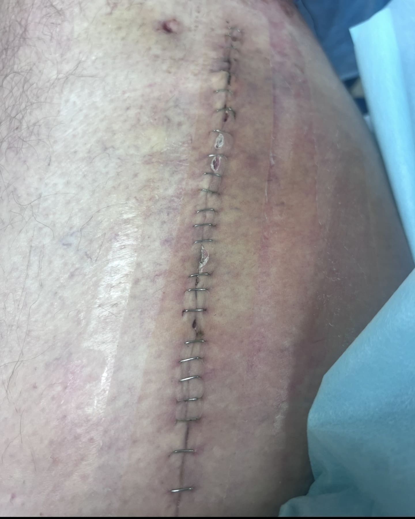 Matthew Cameron-Glaze has since had surgery to remove the cancer and some of the muscle in his leg.