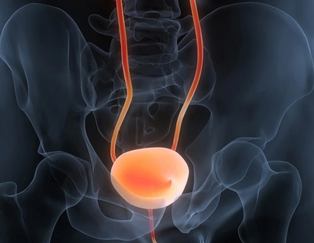 Aspirin use may help unmask early asymptomatic bladder cancer