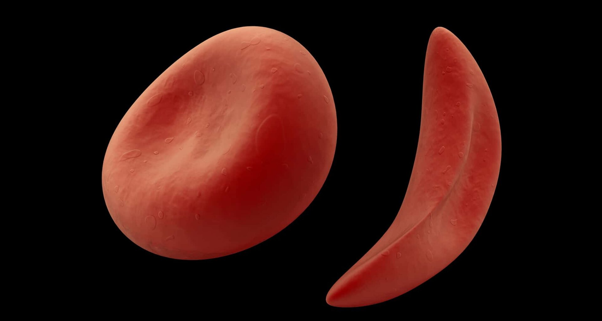 Hydroxyurea Reduced Child Mortality from Sickle Cell Anemia