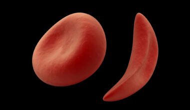 Hydroxyurea Reduced Child Mortality from Sickle Cell Anemia