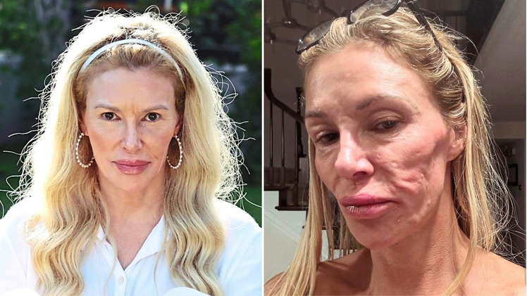 Brandi Glanville Says Her Face Is ‘Sinking in Again’ Amid Ongoing Health Battle