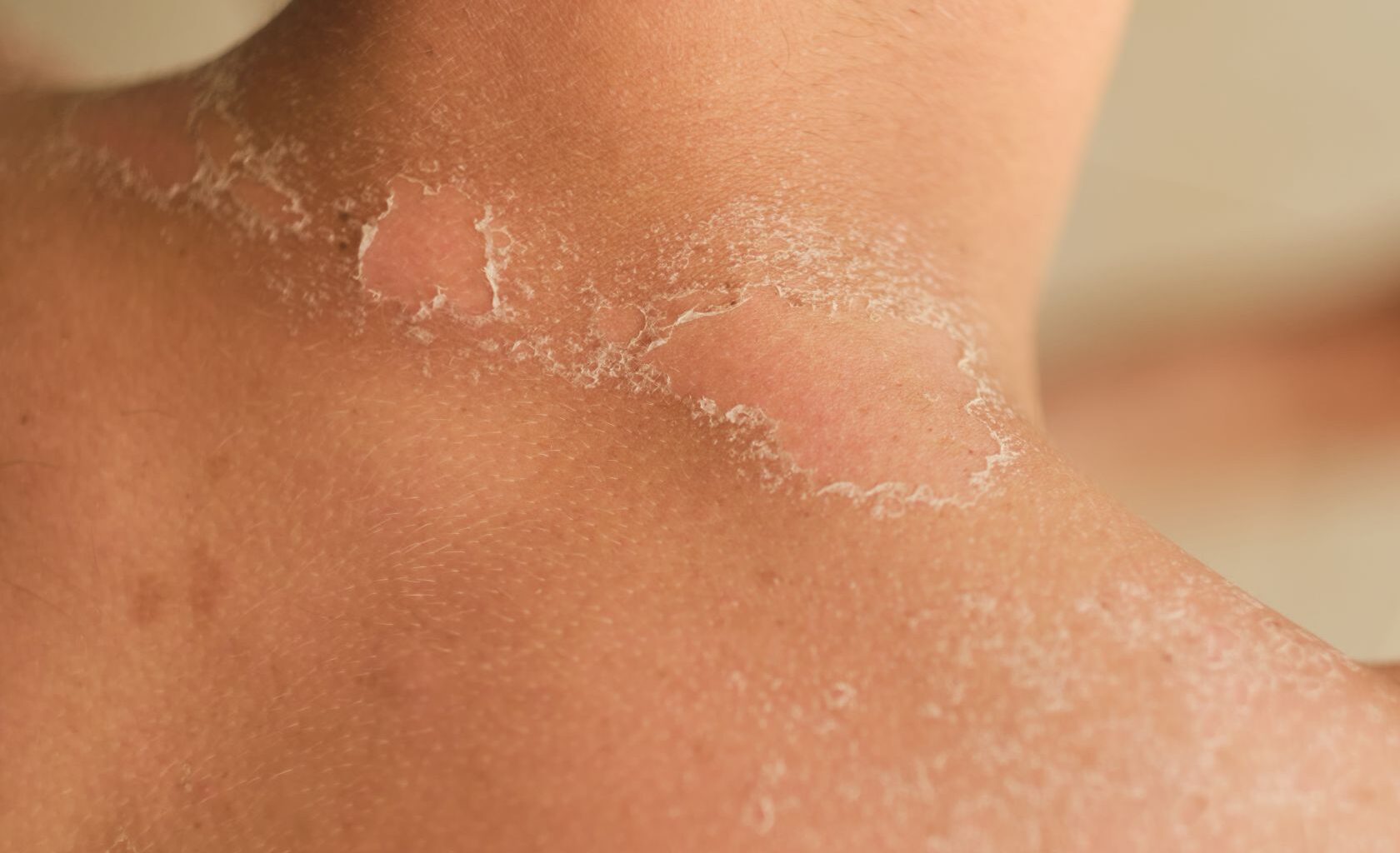 Portugal orders the withdrawal of burn relief product