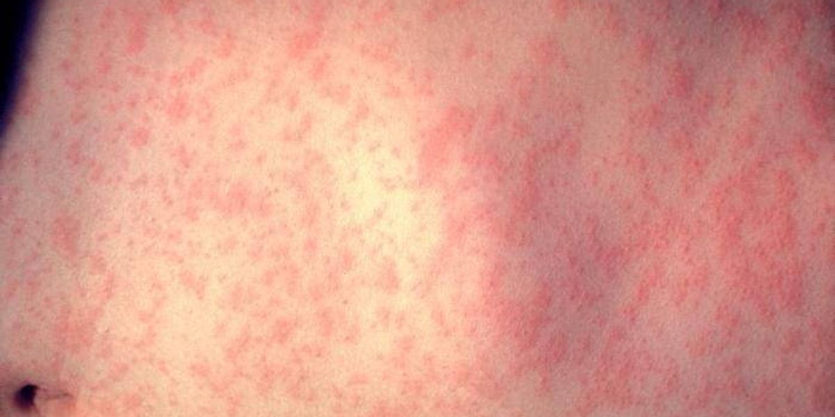 Measles case confirmed in Erie County