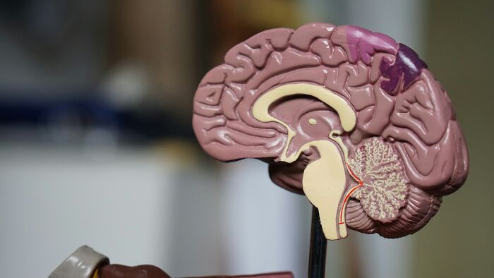 Model of a human brain showing areas affected by dementia and brain health