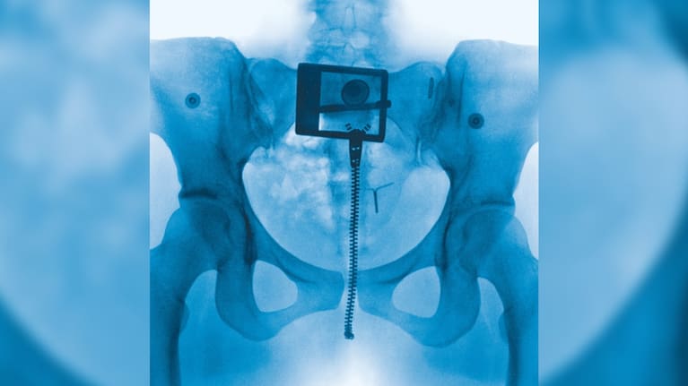 The cover of Virgin — Lorde has revealed the X-ray images were taken at a medical facility with her wearing both her grandmothers' jewellery during the shoot.