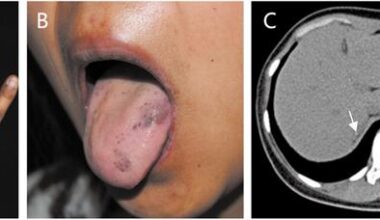 Case Report: Skin Hyperpigmentation as an Early Warning Sign of Addison’s Disease