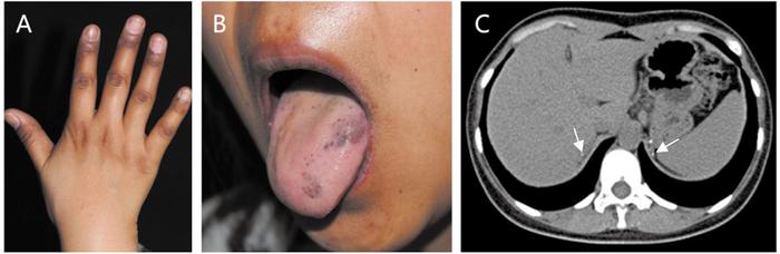 Case Report: Skin Hyperpigmentation as an Early Warning Sign of Addison’s Disease