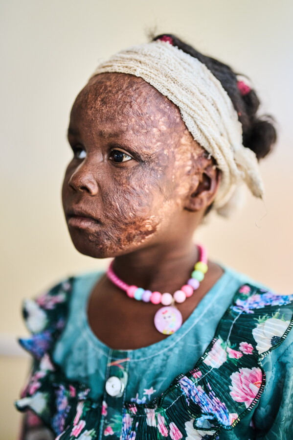 Zeinab Mujhed, 8, who was injured in a shelling attack, poses for a portrait inside Al Nao Hospital in Omdurman, on the outskirts of Khartoum, Sudan, Saturday, April 18, 2026. (AP Photo/Bernat Armangue)