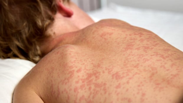 Potential measles exposure at 3 healthcare centres at the end of June: Toronto Public Health